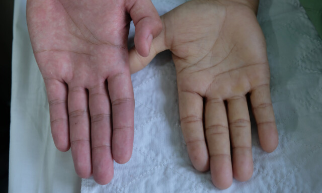 BLEKERE HUDFARGE: Blekere hudfarge kan være et symptom på lav blodprosent. Foto: NTB Scanpix/shutterstock. BLEKERE HUDFARGE: Blekere hudfarge kan være et symptom på lav blodprosent. Foto: NTB Scanpix/shutterstock.